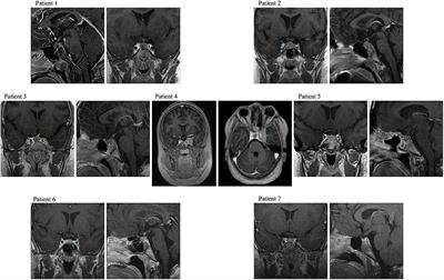 Rare Germline DICER1 Variants in Pediatric Patients With Cushing's Disease: What Is Their Role?